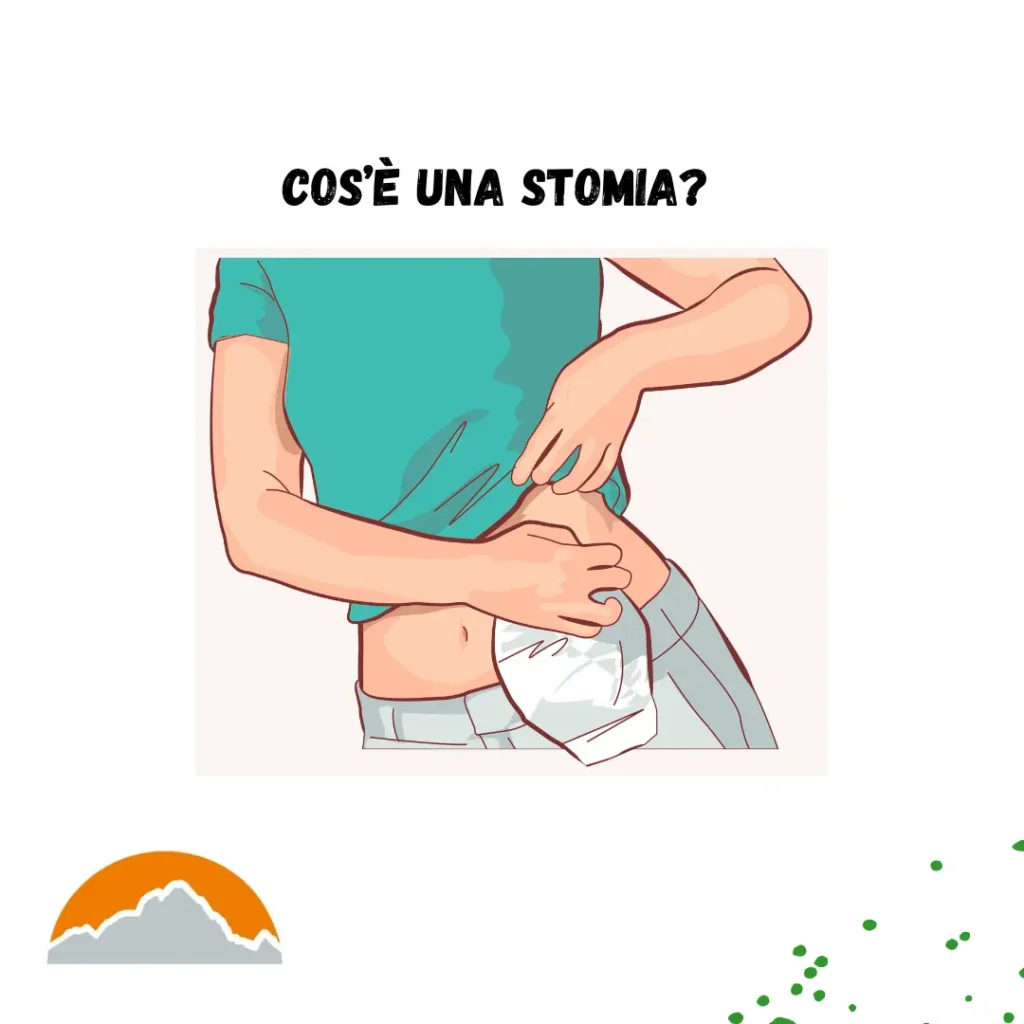 Cos'è una stomia